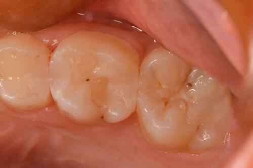 子供の虫歯治療 奥歯 桶川の歯医者 アズ歯科 桶川医院 家族で通える優しい歯医者