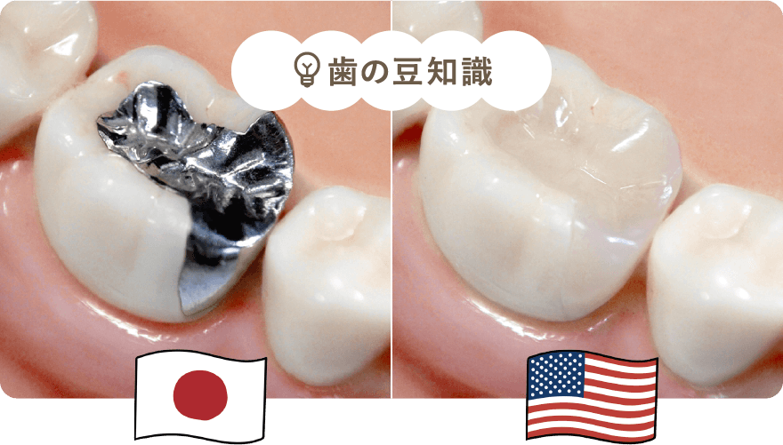 銀歯を用いるのは日本だけ
