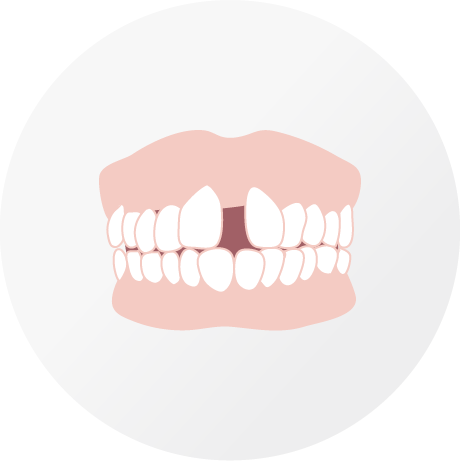 すきっ歯（正中離開･空隙）