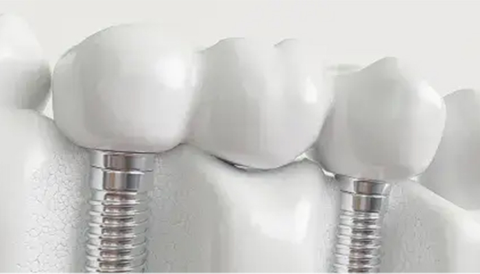 DENTAL IMPLANTS