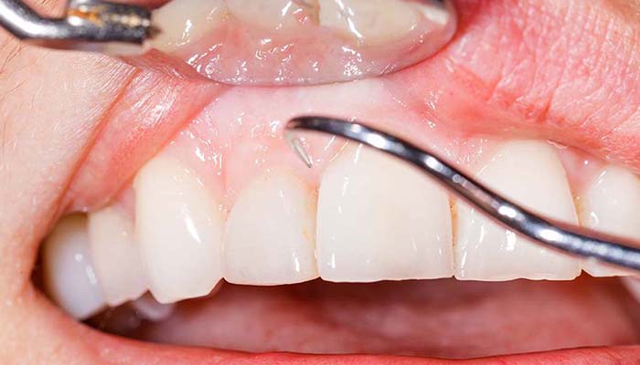 歯の周りの組織への影響