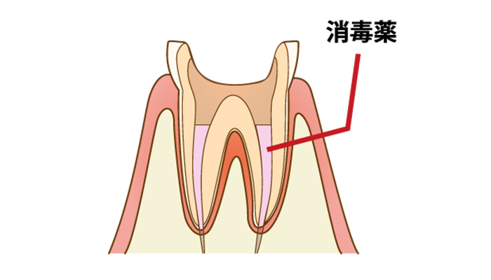 根管充填