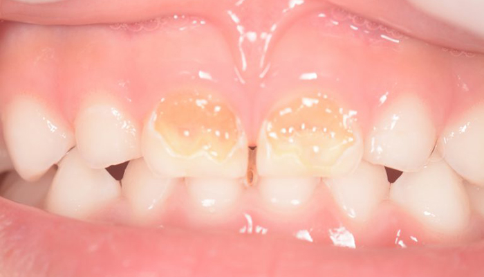 乳歯が虫歯になる原因