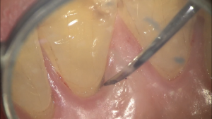 歯茎の中に隠れた歯石 桶川の歯医者 アズ歯科 桶川医院 家族で通える優しい歯医者