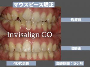 マウスピース矯正 インビザラインgo 桶川の歯医者 アズ歯科 桶川医院 家族で通える優しい歯医者