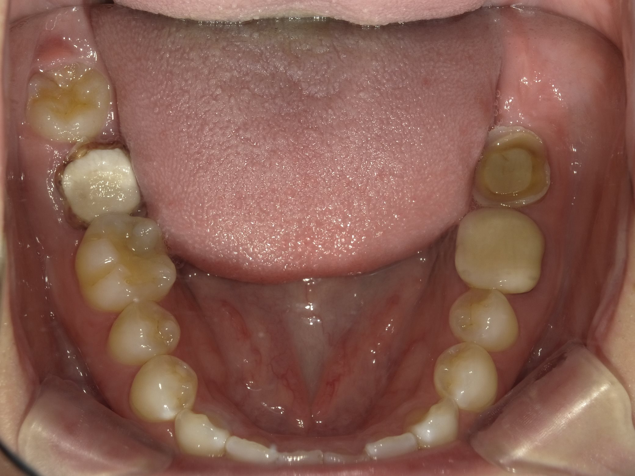 根管治療 アーカイブ - アズ歯科 桶川院