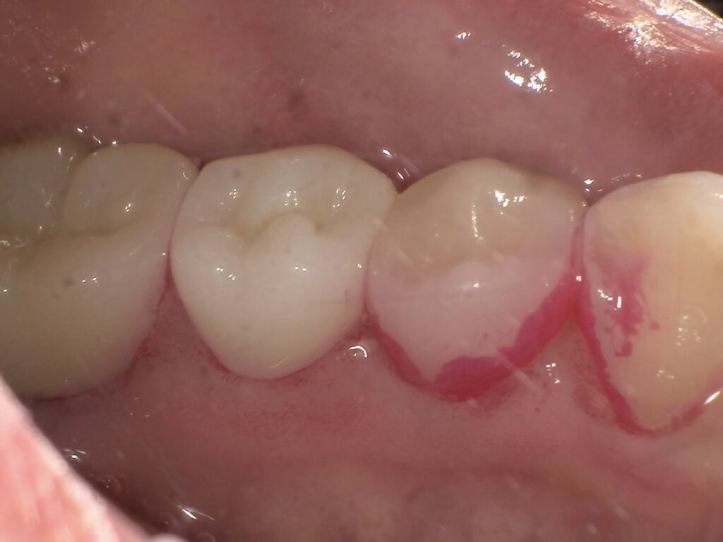 予防歯科 アーカイブ - アズ歯科 桶川院